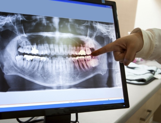 Dentist pointing to digital x rays of teeth on screen