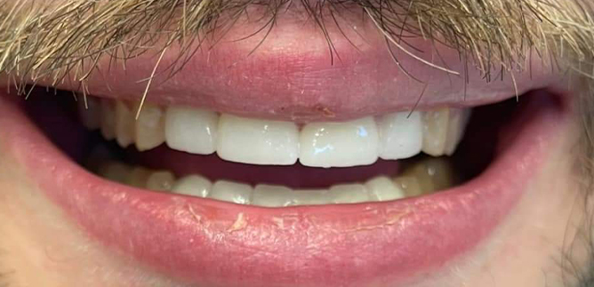 Close up of man with flawless smile after dental treatment