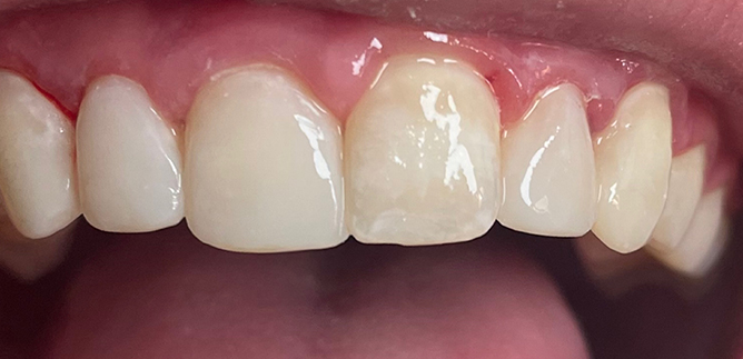 Close up of smile after fixing chipped teeth