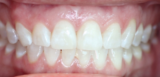 Close up of whiter teeth