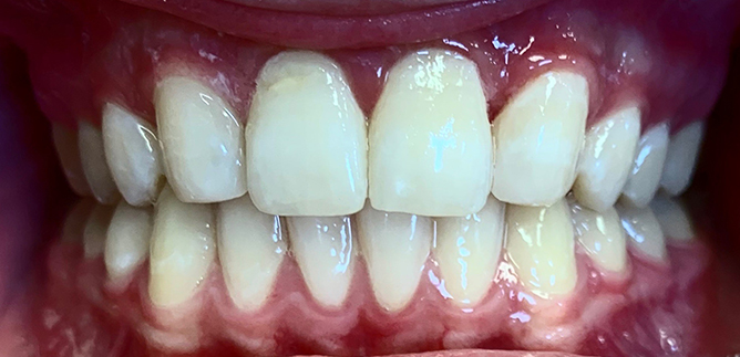 Close up of smile after treating chipped teeth