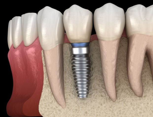 Illustrated dental implant with crown in lower jaw