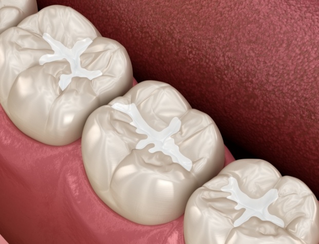 Illustrated close up of teeth with barely noticeable fillings