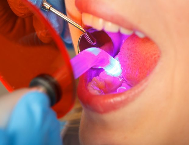 Close up of dental patient getting direct bonding