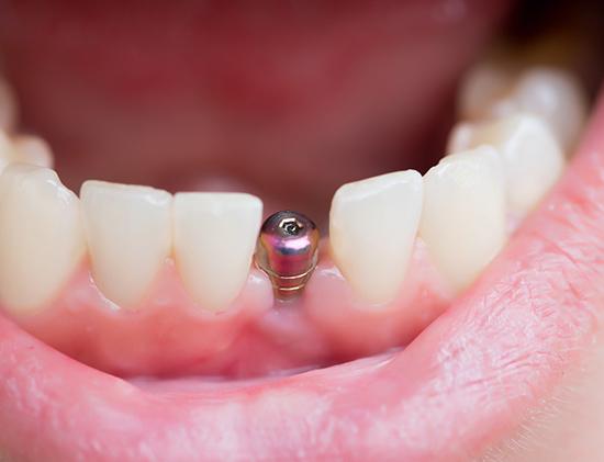 patient smiling with dental implant in mouth 