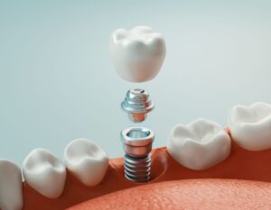 Illustration of a dental implant abutment and crown inserted into a lower arch
