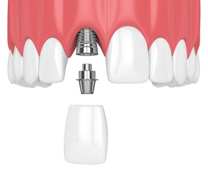 Illustration of front tooth being replaced by dental implant